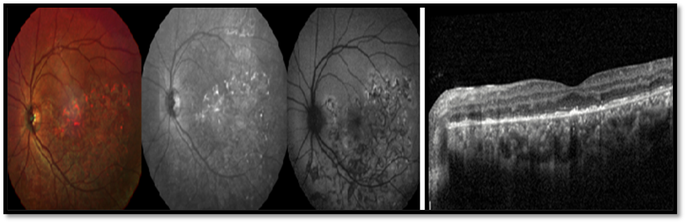 Figure 5: In an eye with serpigenous choroidopathy, MCI showing the lesions with a reddish hue and on the IR image lesions were hyperreflective. On FAF where they appeared hypo autofluorescent. OCT showed diffuse EZ loss with multiple foci of hyperreflective RPE and demonstrated HRF in the outer retina and choroid.