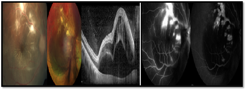 Figure 6: Fundus CP showing vasculitis, MCI picked up the retinochoroidal lesion and OCT showing serous detachment. FFA and ICGA identified the patchy vascular leakage which appeared to be venular in the periphery predominantly