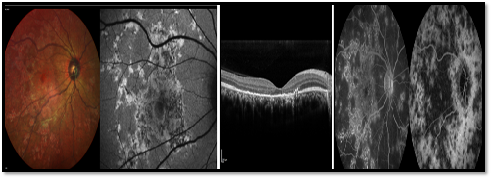 Figure 7: Multifocal choroiditis, on IR image these lesions were hyperreflective. On the OCT there was patchy EZ and ELM loss with involvement of the overlying retina also and demonstrated HRF in the outer retina and choroid. On FFA the lesions demonstrated increased fluorescence while appeared hypofluorescent in ICGA.