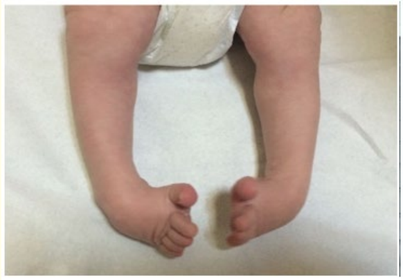 Figure a: Down Sd and clubfoot at birth.
