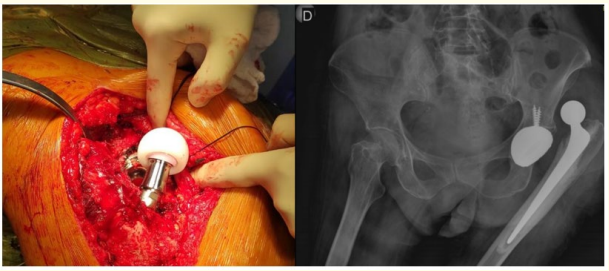 Figure 1: Intraprosthetic dislocation of dual mobility total hip
arthroplasty. Left: clinical image. It is observed how the liner
remains attached to the femoral head. Right: AP pelvic x-ray
showing dislocation of left hip prosthesis. Above the dislocated
prosthetic head there is a shadow that could correspond to the
PE liner fixed to prosthetic head.