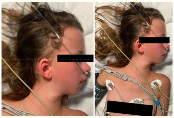 Figure 1: Two weeks after the onset of symptoms, fixed
left-sided cephalic rotation and head tilt > 20°.