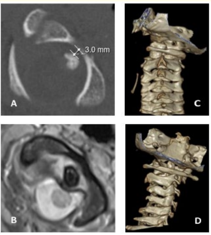 Figure 2: Ten-year-old girl with persistent torticollis for 2
weeks. A: Cervical CT showing 3 mm anterior displacement of
C1 (Fielding-Hawkins type III). B: Cervical MRI T2-weighted
showing ligamentous rupture. C and D: Preoperative rotation of
20° in 3D reconstructions.