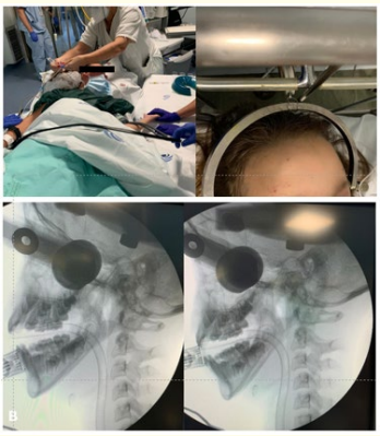 Figure 3: A: Cervical traction adjusted under general
anesthesia and closed reduction. B: Initially radiological control
showed no loss of reduction or consequent subluxation.