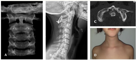 Figure 4: At 2 years of follow-up. A and D: Normal
cervico-cephalic alignment. B: Achieved arthrodesis. C:
Cervical CT showing no anterior displacement of C1 (distance
1.2 mm).