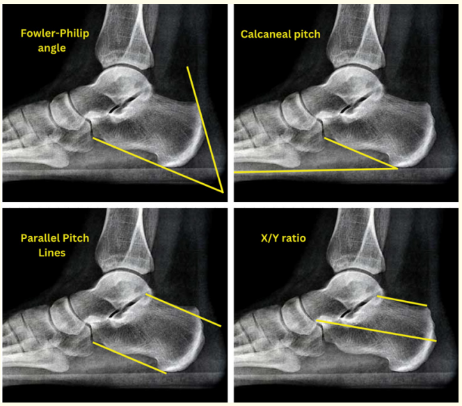 Figure 1: Radiological Indices for measurement of Haglund’s
deformity.