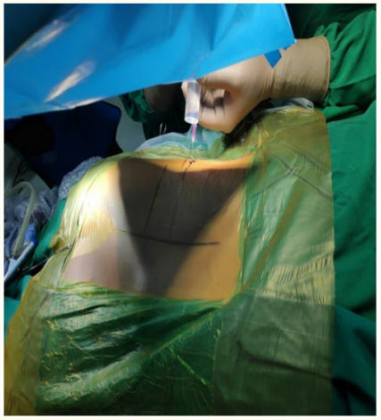 Figure 3: Local anaesthesia infiltration.