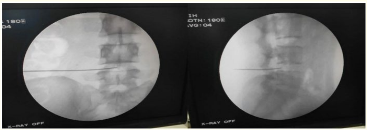 Figure 4: Needle insertion.
