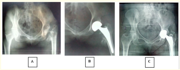 Figure 1: Intermediate hip prosthesis in a 63-year-old patient. <br> 
A = Pseudarthrosis of the femoral neck <br> 
B = Postoperative control at D1 <br> 
C = Control at 3 years postoperative with cotyloiditis.