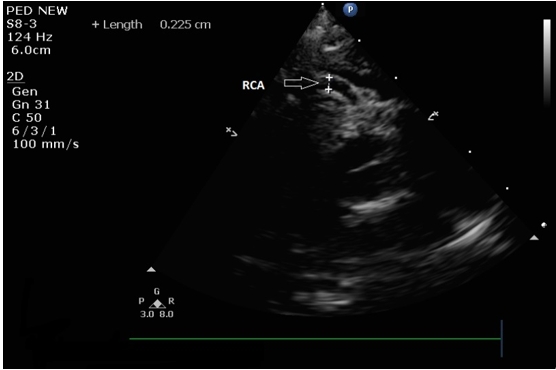 Figure 2: Echocardiogram showing dilated right coronary
artery originated normally from the right sinus of Valsava
(RCA: Right Coronary Artery).