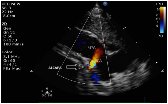 Figure 3: Echocardiogram showing the anomalous left
coronary artery from the pulmonary artery. There is
 retrograde red flow into the main pulmonary artery
(LCA: Left Coronary Artery; LAD: Left Anterior Descending;
MPA: Main Pulmonary Artery; ALCAPA: Anomalous Left
Coronary Artery from Pulmonary Artery).