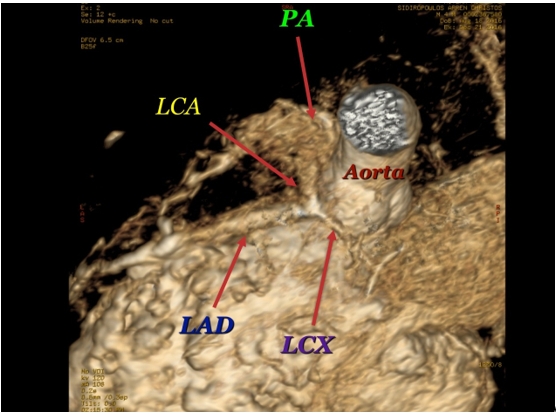 Figure 4: MRI: The left coronary artery (LCA) originates
from the pulmonary artery (PA). LAD: Left Anterior
Descending, LCX: Left Circumflex.