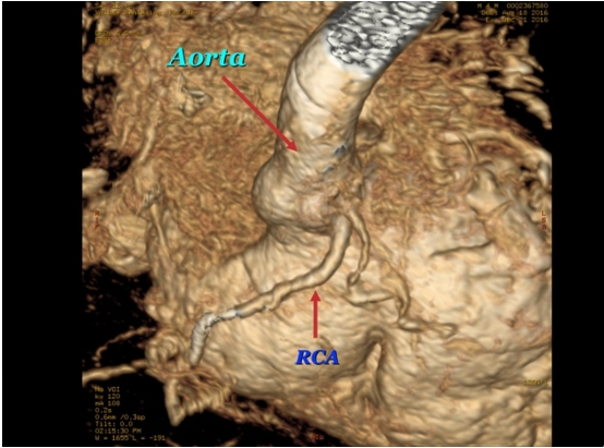 Figure 5: MRI. The right coronary artery (RCA) originates
above the right cusp of the aortic valve and the right aortic
sinus. At the origin of the RCA is the conus artery.