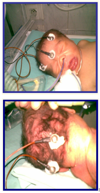 Figure 1: EEG electrodes connected to the infant’s head.