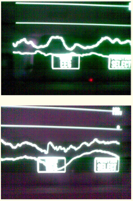 Figure 5: Abnormal EEG discharges as observed