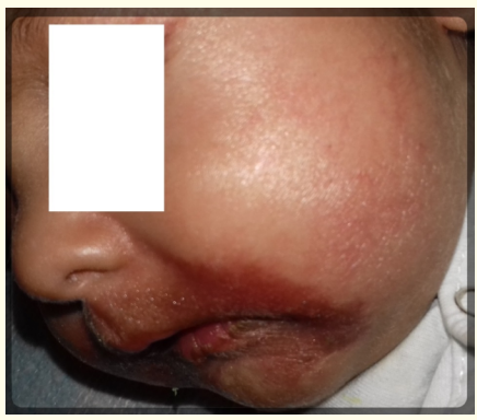 Figure 1: Hemorrhagic rash on the lips and periorally.