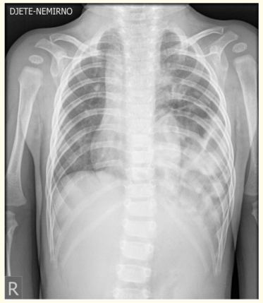 Figure 1: Chest X-ray air-filled loops of the bowel in the left hemithorax and a paucity of gas in the abdomen. The left diaphragm is
not discernable and there is an mediastinal shift to the right site.