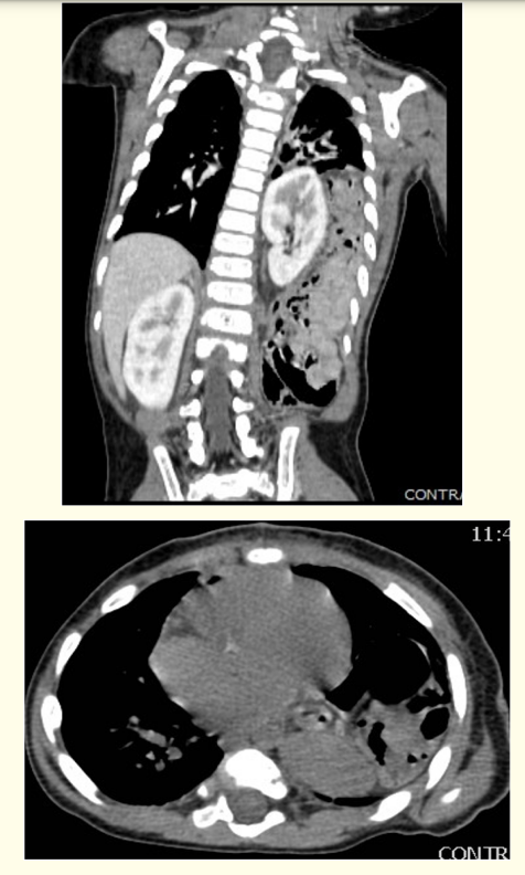 Figure 2 and 3: Thorax CT showing herniation of bowel and
kidney into the left side of the thorax.