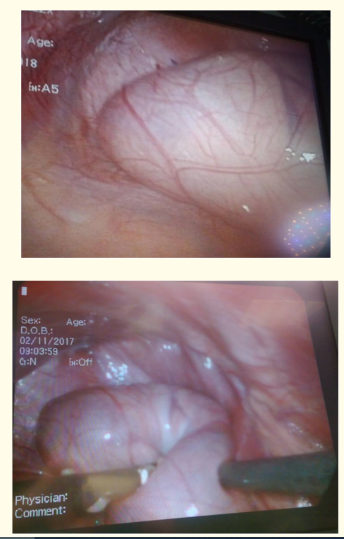 Figure 4 and 5: Thoracoscopic view of the hernia sac showing
kidney and small bowel loops impression.