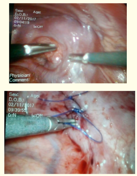 Figure 6 and 7: Defect of the diaphragm after the renal reposition into the abdominal cavity and closure the diaphragm with
2-0 non-resorptive suture.