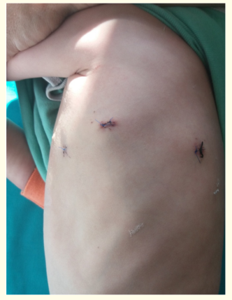 Figure 8: The appearance of the chest at the tenth
postoperative day.