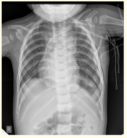 Figure 9: The control Rtg chest shows the normal appearance of
the left diaphragm.