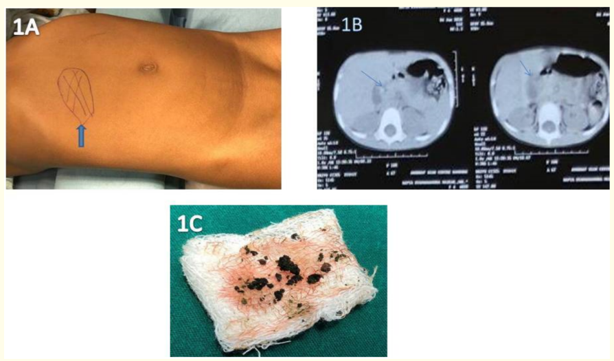 Figure 1: A) Demonstration of site of tenderness and mass( Right Hypochondriac region).
B) CT Abdomen showing distended gall bladder and a radio-dense calculus in the neck of gallbladder.
C): The calculus removed in pieces from the cholecystectomy specimen. 