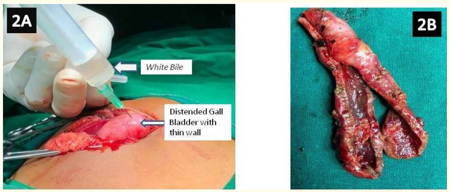 Figure 2: A) Intraoperative photo showing colourless mucous fluid aspirated from the distended Gall Bladder.
B) Cholecystectomy specimen.