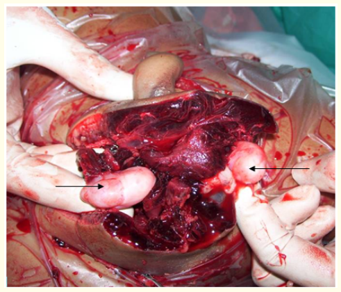 Figure 2: Peroperative photograph after debridement
showing bilateral normal testis (pointed by arrows).