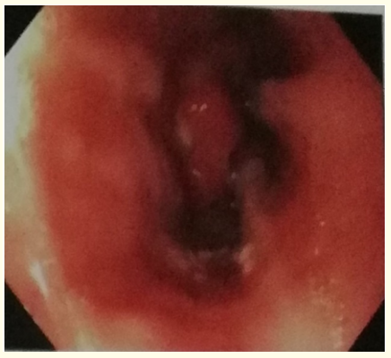 Figure 1: Upper GI endoscopy showing OG junction
with hiatus hernia.