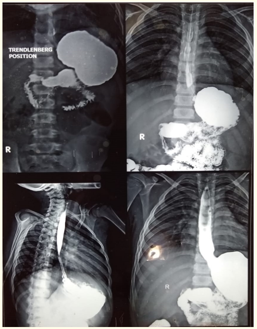 Figure 2: Barium meal study shows normal anatomy of GI tract.