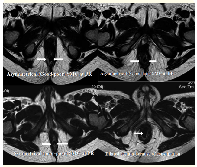 Figure 1: MRI sections at I line at 3’ and 9’ o clock position at PR
(c) Scoring 2 because of asymetrical (good-poor) SMC; (a) scoring
1 because of asymmetrical (good-fair) SMC, (b) scoring 0 because
of symmetrical (poor-poor) SMC, 1(d) dilated rectum because of
constipation after LAARPT.