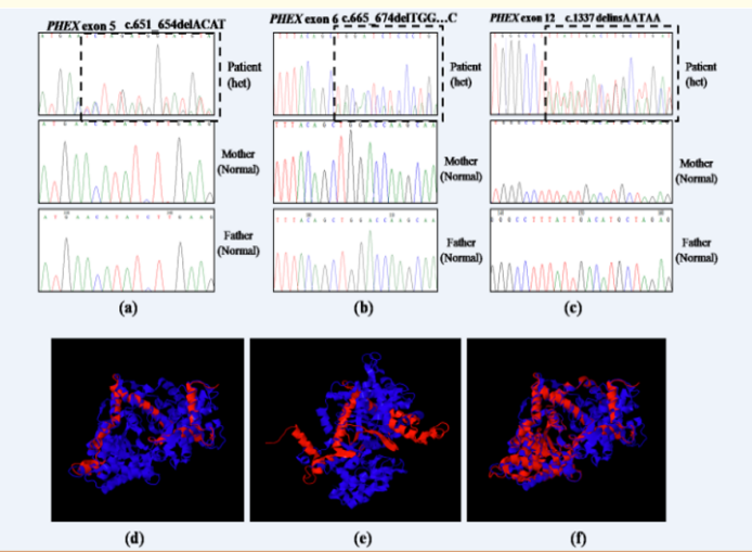 Figure 1: Novel PHEX mutations identified in our study. (a–c)
Chromatograms containing novel mutations are shown in
comparison to the normal sequences. (a) c.651_654delACAT
in exon 5, (b)c.665_674delTGGACCAAGC in exon 6, and (c)
c.1337delinsAATAA in exon 12. Superimposed images of normal
(blue) and mutant PHEX protein (red). The novel PHEX mutations
(d) c.651_654delACAT in exon 5, (e) c.665_674delTGGACCAAGC
in exon 6, (f) c.1337delinsAATAA in exon 12 resulted in truncated
PHEX protein (red).