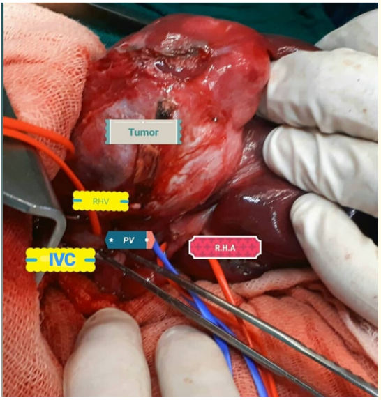 Figure 2: Intraoperative view.