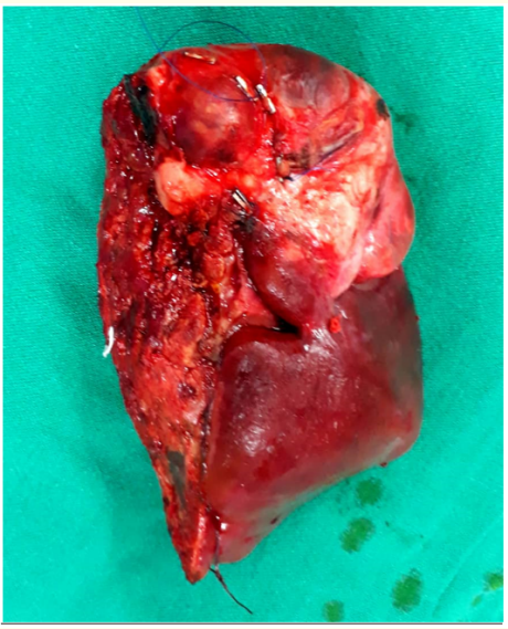 Figure 4: The speciment (right liver lobe Lsg V-Vlll).
