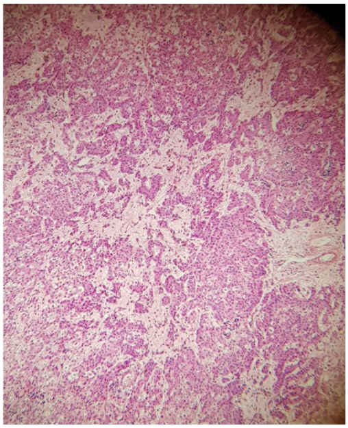 Figure 6: Post treatment effect with hyalinization.
