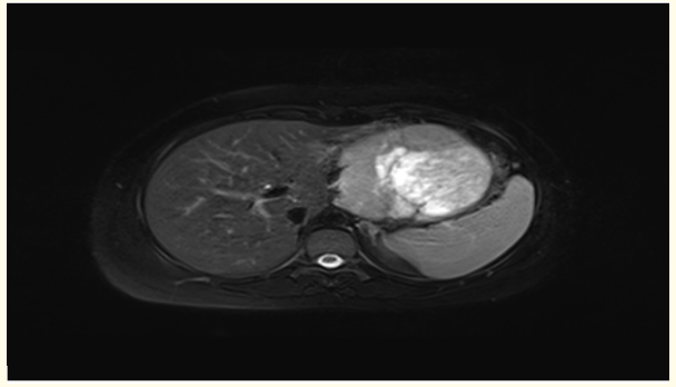 Figure 1: Abdominal CT.