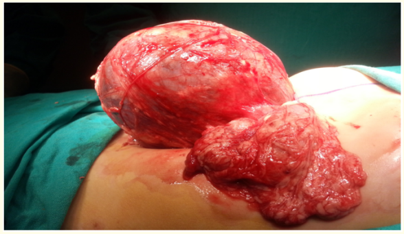 Figure 2: Total resection.