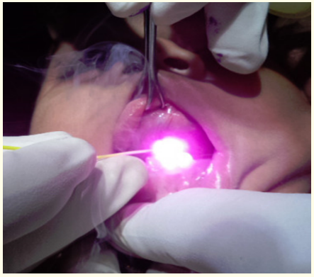 Photo 1: Frenotomy operation by methylene blue
dye induced infrared laser cutting.