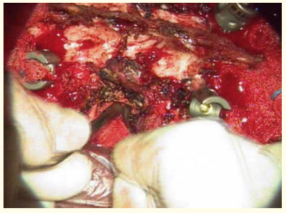 Figure 1: Meticulous sub-periosteal elevation off the
 lateral vertebral body & antero-lateral dissection with
protection of pleural sac.