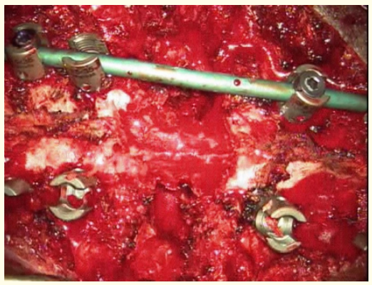 Figure 4: Removal of posterior elements with kerrison
ronguer and stabilization with rod on one side.