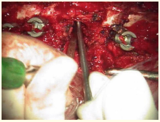 Figure 5: Breaking the posterior wall of vertebral
body with reverse angled curette.