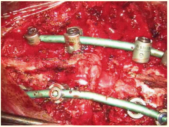 Figure 7: Closure of osteotomy the compression to correct
deformity in both sagittal and coronal planes.