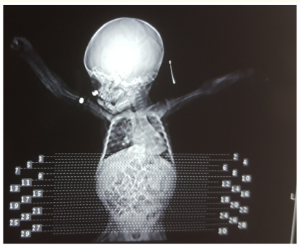 Figure 1: Chest CT topogram shows decreased lung volume on
the left side, increased lung volume on the right side and
mediastinal shift to the left.