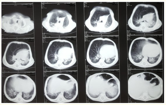 Figure 2: Chest CT scan shows decreased size of the left lung,
increase in the right lung volume, herniation of the right lung
towards the left side and cardiac shift into the left hemithorax.
