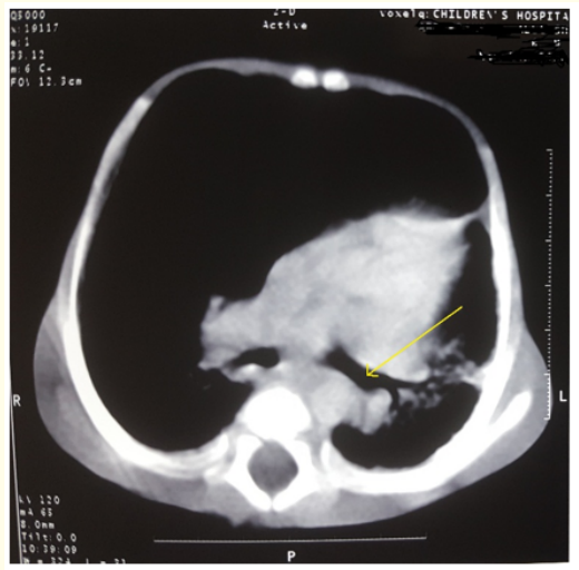 Figure 3: Chest CT scan shows the left main bronchus
(yellow arrow).

