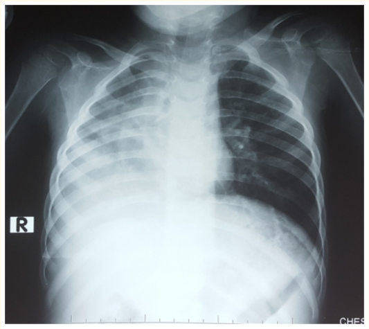 Figure 4: CXR shows deviation of mediastinum to the right
with increased opacity on the right hemithorax and compensatory
hyperinflation of the left hemithorax.

