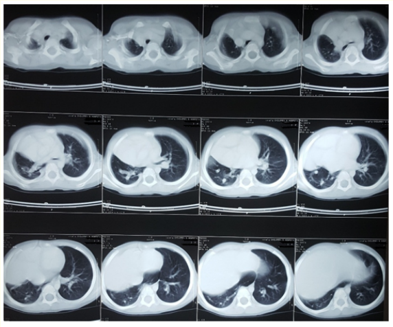 Figure 5: Chest CT scan shows reduced volume of the right
lung parenchyma with increase in the left lung volume and cardiac
shift into the right hemithorax.