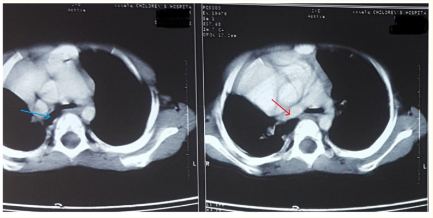 Figure 6: Chest CT scan shows the right main bronchus
(blue arrow) and the right pulmonary artery (red arrow).