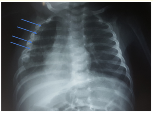 Image 1: CXR: Hyperlucent area in the right lung
(Blue arrows).